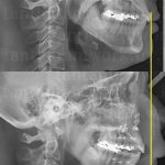 1【韓国整形】ルフォーIVRO両顎手術翌日からの経過EU口腔外科＆渡韓サポーター青い魔女